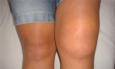 The causes of knee articulation arthrosis