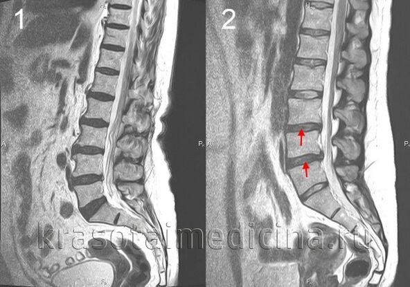 Spine osteochondrosis