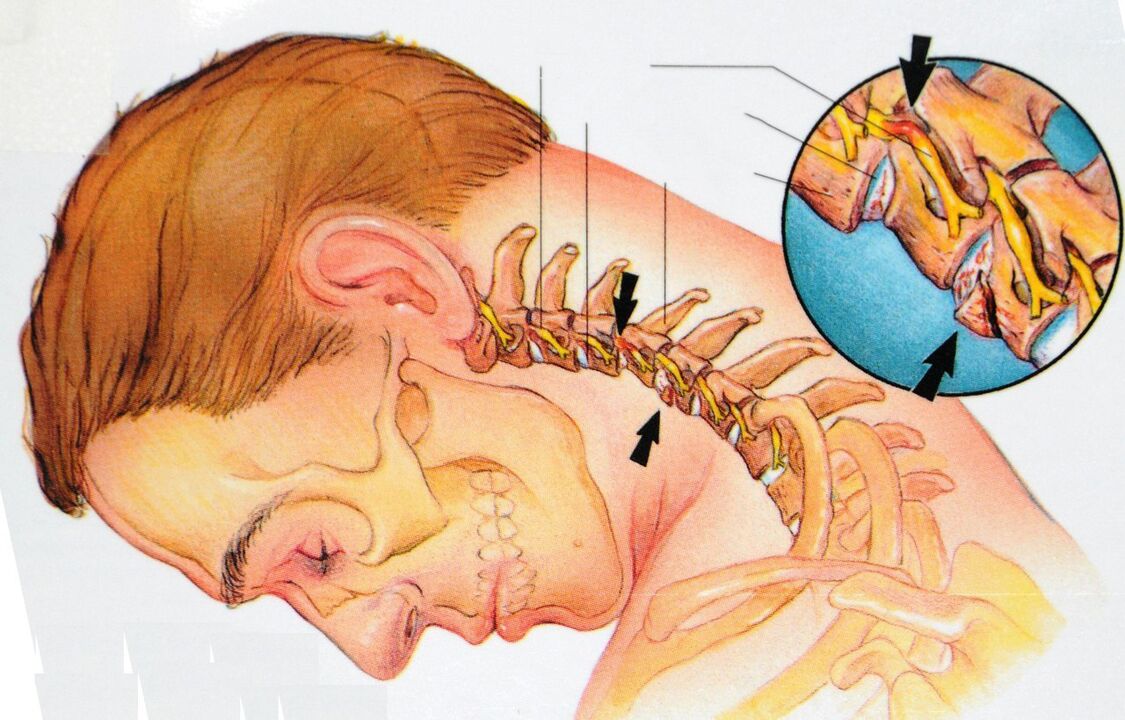 Osteochondrosis of the cervical region