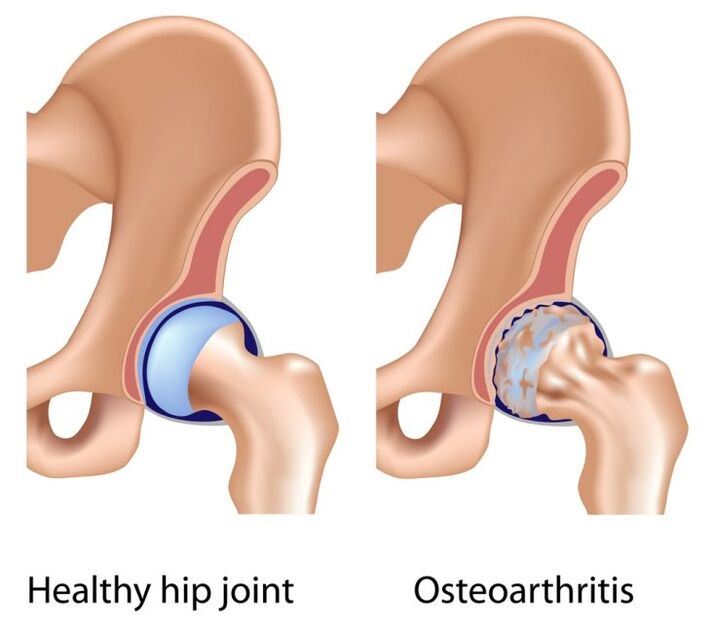healthy joint and osteoarthritis of the hip joint