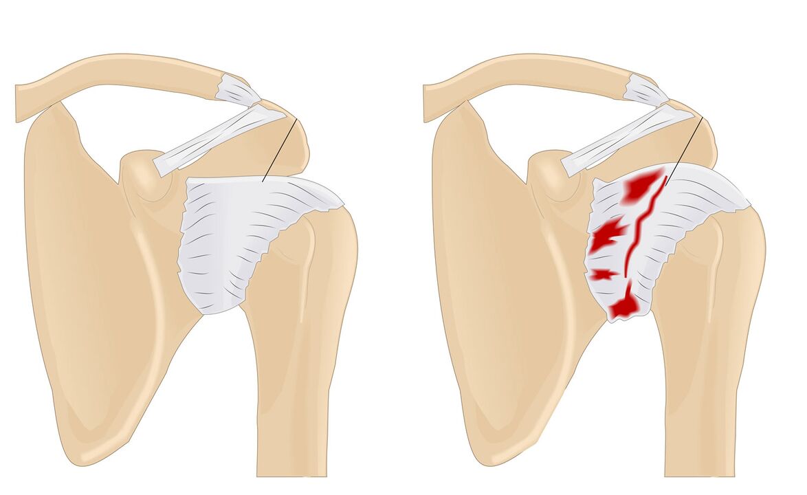 normal and affected joint